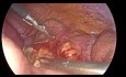 Laparoskopowa appendektomia u ciężarnej kobiety