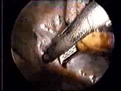 Appendectomia laparoskopowa