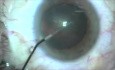 Ablacja z użyciem ostrza Fugo w zaćmie - przyszłość okulistyki 
