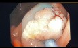 Endoskopowa resekcja płaskiego polipa w kątnicy