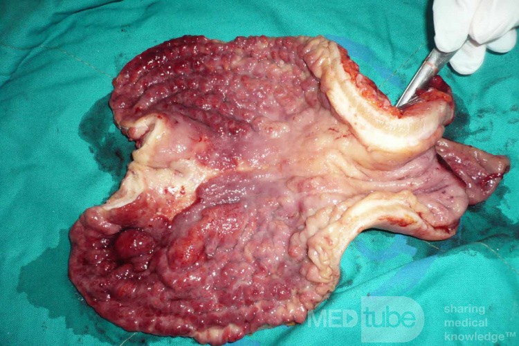 Obraz endoskopowy raka włóknistego żołądka obejmującego dno, trzon i część przedodźwiernikową (29 z 47)