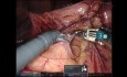 Median Arcuate Ligament Syndrome Robotic Celiac Axis Release & Celiac Plexus Neurolysis