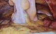 Reseccion anterior ultra baja mas ileostomia de seguridad en paciente con colostoma en asa de seguridad post neoadyuvancia