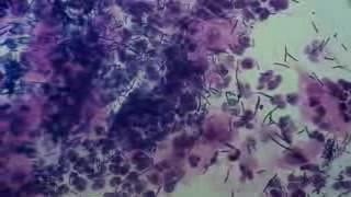 Leukocytoza - Badanie cytologiczne
