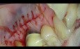 Mikrochirurgia periodontologiczna: przeszczep tkanki łącznej