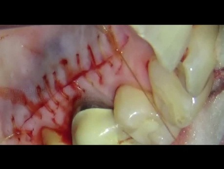Mikrochirurgia periodontologiczna: przeszczep tkanki łącznej