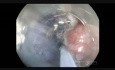 Endoskopowa dyssekcja podśluzówkowa (ESD) gruczolaka esicy