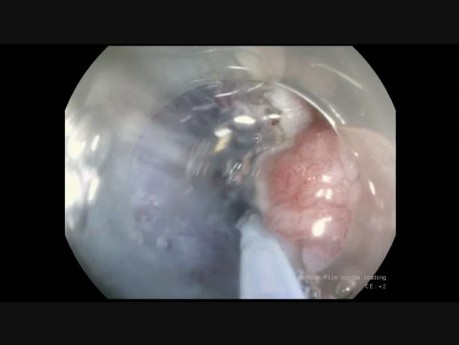 Endoskopowa dyssekcja podśluzówkowa (ESD) gruczolaka esicy