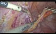 Węzeł wartowniczy w raku trzonu macicy - detekcja przy użyciu ICG