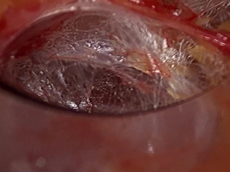 Dwuportowa przezpodobojczykowa endoskopowa operacja tarczycy
