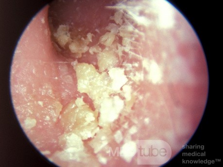 Łuszczyca w przewodzie słuchowym zewnętrznym