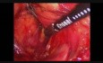 Laparoskopowa resekcja obwodowa trzustki z powodu guza neuroendokrynnego