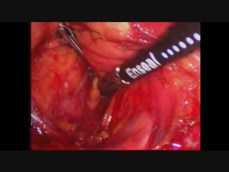 Laparoskopowa resekcja obwodowa trzustki z powodu guza neuroendokrynnego