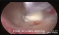 Histeroskopowa resekcja mięśniaka macicy