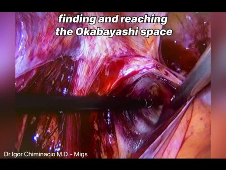 Operacja endometriozy - Wertheim-Okabayashi 