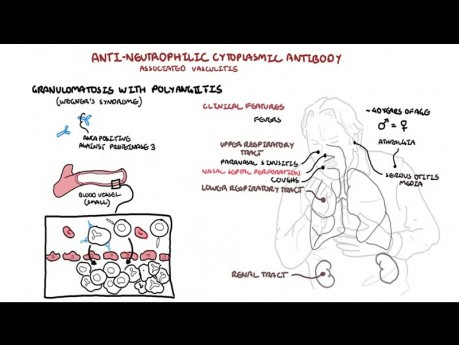 Ziarniniakowatość z zapaleniem naczyń (ziarniniak Wegenera) - patofizjologia, objawy i postępowanie