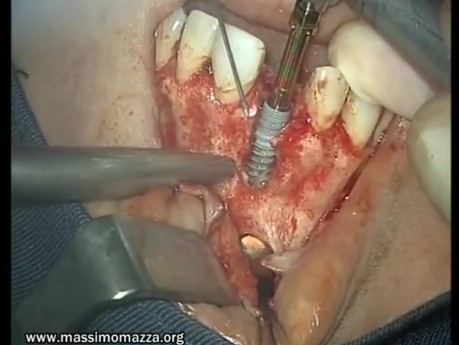 Implant śródkostny - rekonstrukcja kostna