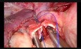 Utrudnione torakoskopowe zespolenie oskrzelowe (Rękawowa resekcja płata górnego płuca prawego)