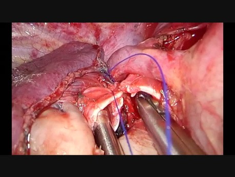 Utrudnione torakoskopowe zespolenie oskrzelowe (Rękawowa resekcja płata górnego płuca prawego)