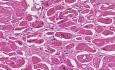 Amyloidoza - serce - histopatologia