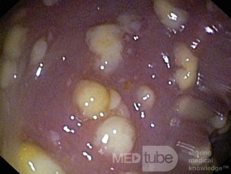 Rzekomobłoniaste zapalenie jelita grubego - obraz endoskopowy