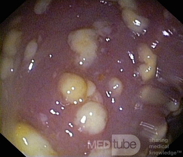 Rzekomobłoniaste zapalenie jelita grubego - obraz endoskopowy