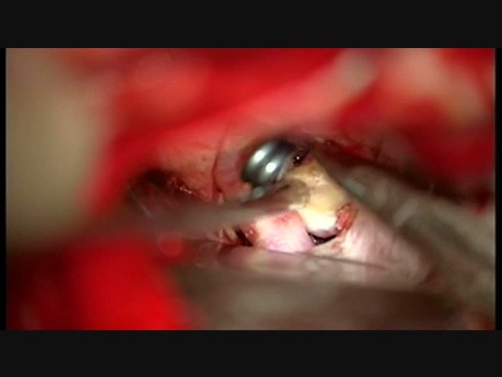 Klipsowanie tętniaka tętnicy łączącej tylnej
