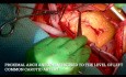Tętniak aorty wstępującej z proksymalnym zajęciem łuku aorty