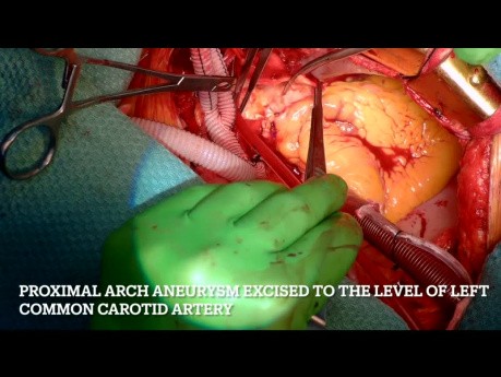 Tętniak aorty wstępującej z proksymalnym zajęciem łuku aorty