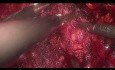 Laparoskopowa adenomektomia 