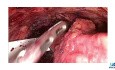 Laparoscopic Implantation of an Artificial Urinary Sphincter in a Pediatric Female