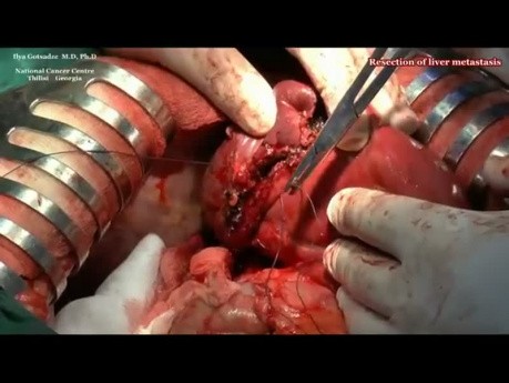 Cytoredukcyjna chirurgia w zaawansowanym raku jelita grubego