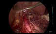 Laparoskopowa kardiomiotomia Hellera +  fundoplikacja Dora