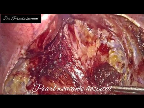 Laparoskopowa waginoplastyka otrzewnowa