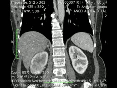 Tromboembolektomia żyły głównej dolnej z nefrektomią