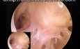 Zachyłek podbębenkowy - jama bębenkowa (ucho środkowe)