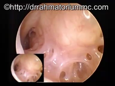Zachyłek podbębenkowy - jama bębenkowa (ucho środkowe)