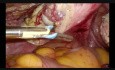 Całkowita laparoskopowa histerektomia z wykorzystaniem nożyczek bipolarnych 
