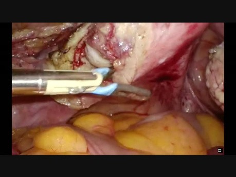 Całkowita laparoskopowa histerektomia z wykorzystaniem nożyczek bipolarnych 