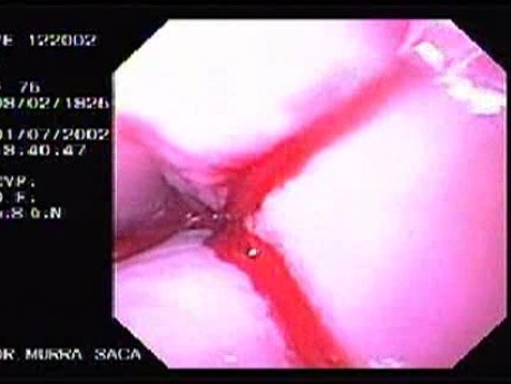 Krwotok - podwiązywanie żylaków przełyku (gumowa opaska) - krwawienie po skleroterapii