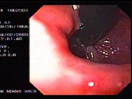 Podwiązywanie żylaków przełyku - badanie endoskopowe (inwersja) zmian po opaskowaniu