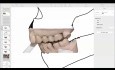 Syndrom "ostatniego zęba w łuku"