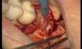 Postępowanie w trakcie zabiegu wszczepiania implantu zębowego (1/2)