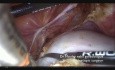 Adneksektomia z powodu dużej torbieli śluzowatej jajnika