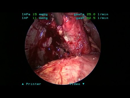 Zespół Mirizziego - postępowanie laparoskopowe