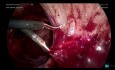 Laparoskopowa salpingektomia lewostronna z uwalnianiem zrostów z powodu wodniaka jajowodu - część 3