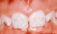 Hipoplazja zębów