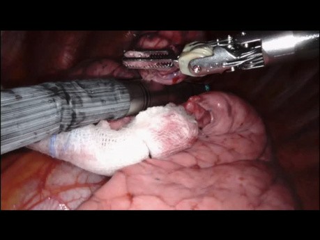 Resekcja guza płuca lewego przy użyciu robota