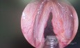 Laryngeal Papillomas Ablation and Vaporization