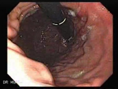 Żołądek klepsydrowaty - wrzody w inwersji endoskopowej